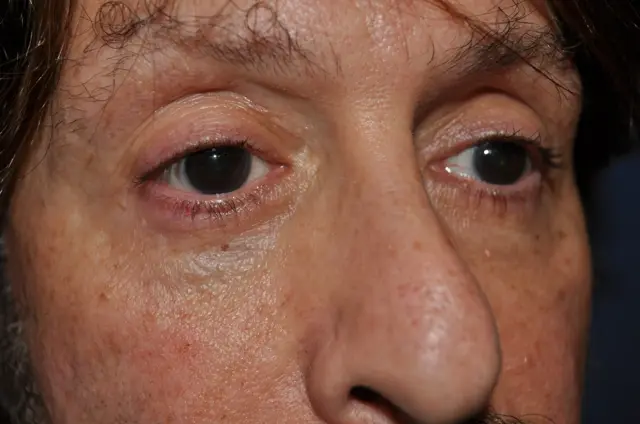 Blepharoplasty after at Aesthetic Surgery Center: Michael R. Macdonald, M.D. in San Francisco, CA