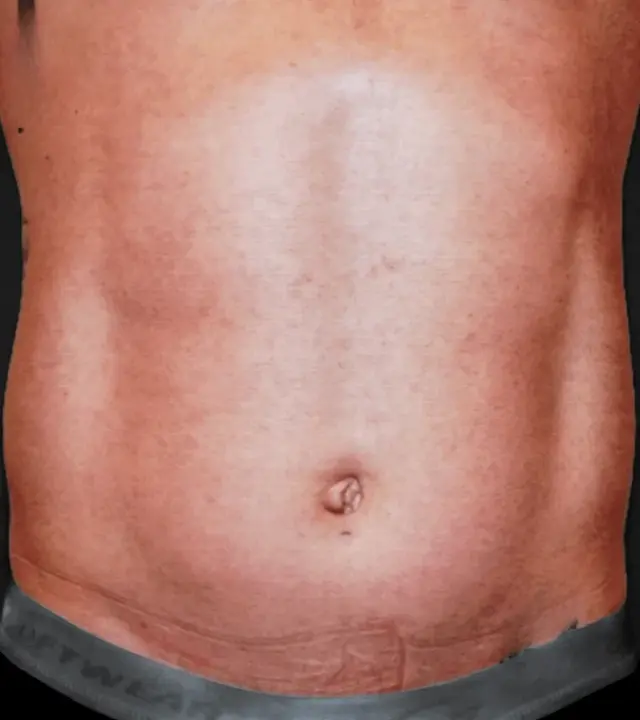 Liposuction before at Aesthetic Surgery Center: Michael R. Macdonald, M.D. in San Francisco, CA