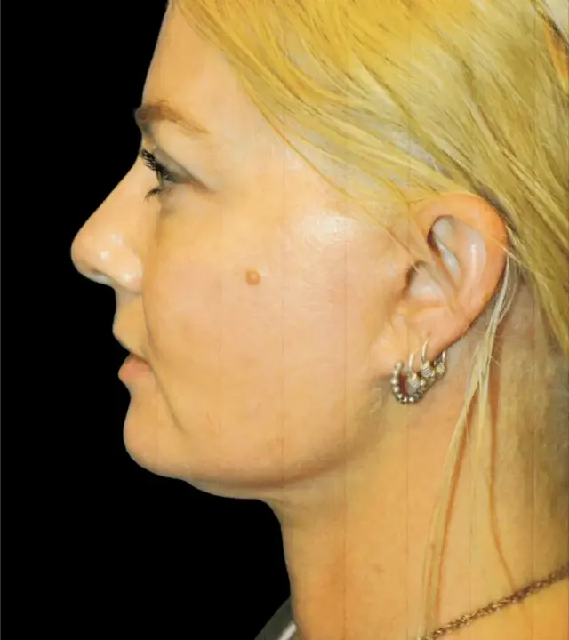 Deep Plane Facelift after at Aesthetic Surgery Center: Michael R. Macdonald, M.D. in San Francisco, CA
