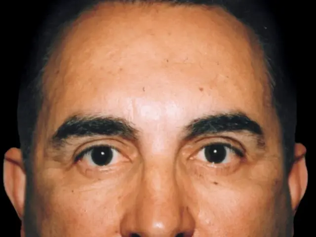 Brow Lift before at Aesthetic Surgery Center: Michael R. Macdonald, M.D. in San Francisco, CA