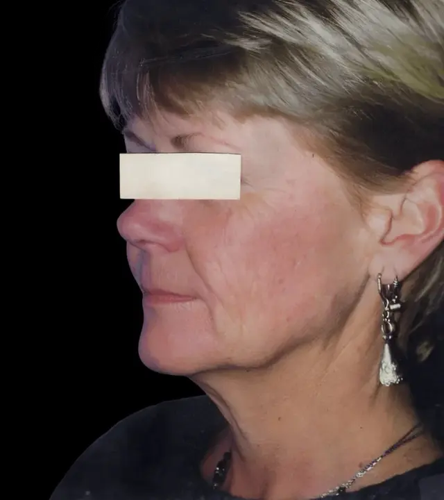 Deep Plane Facelift before at Aesthetic Surgery Center: Michael R. Macdonald, M.D. in San Francisco, CA
