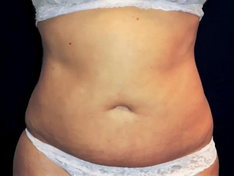 Aesthetic Surgery Center: Michael R. Macdonald, M.D. liposuction after — San Francisco, CA
