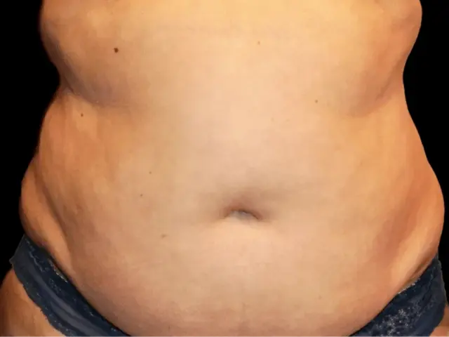 Liposuction before at Aesthetic Surgery Center: Michael R. Macdonald, M.D. in San Francisco, CA