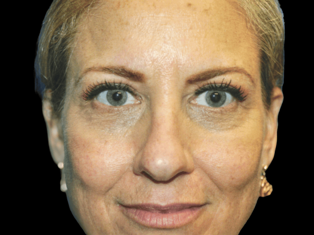 Neck Lift after at Aesthetic Surgery Center: Michael R. Macdonald, M.D. in San Francisco, CA