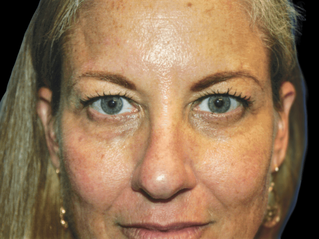 Neck Lift before at Aesthetic Surgery Center: Michael R. Macdonald, M.D. in San Francisco, CA