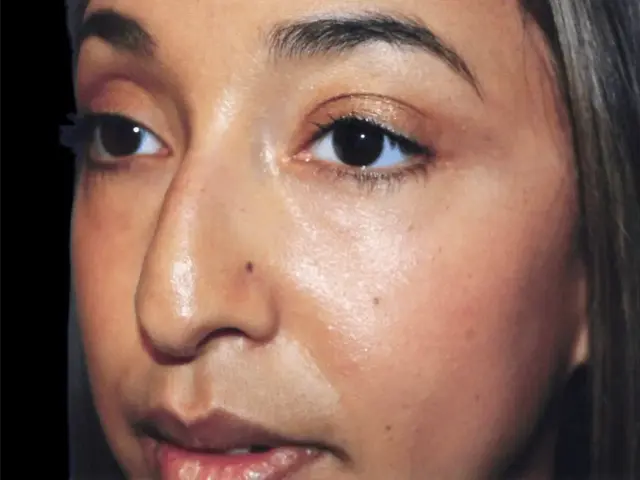 Functional Rhinoplasty before at Aesthetic Surgery Center: Michael R. Macdonald, M.D. in San Francisco, CA