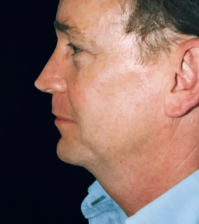 Neck Liposuction before at Aesthetic Surgery Center: Michael R. Macdonald, M.D. in San Francisco, CA