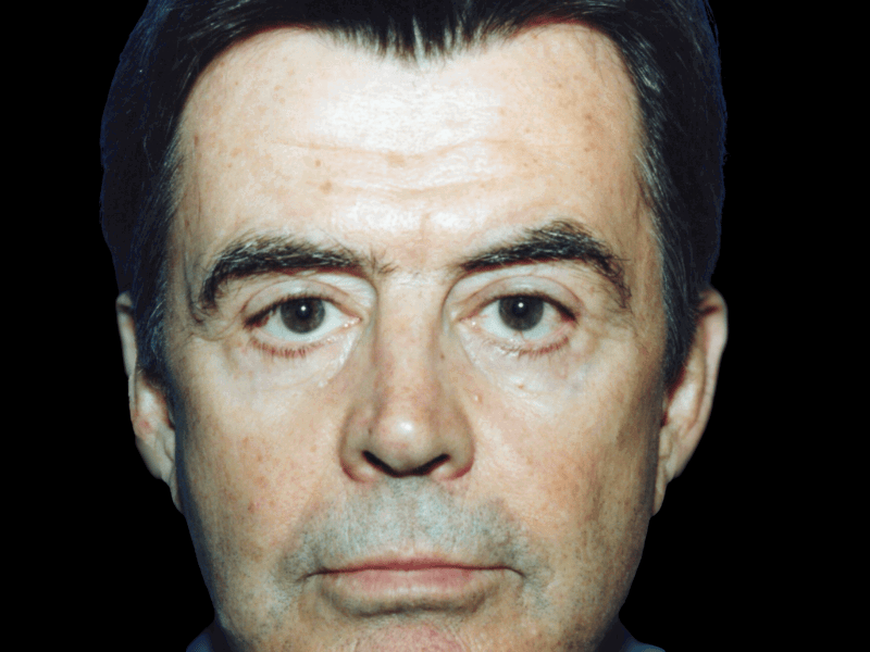 Aesthetic Surgery Center: Michael R. Macdonald, M.D. neck lift after — San Francisco, CA