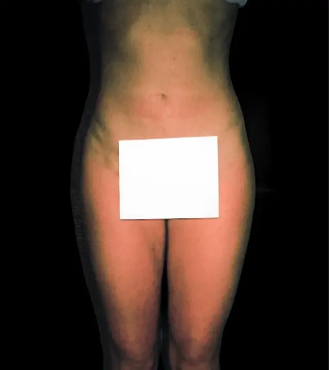 Liposuction after at Aesthetic Surgery Center: Michael R. Macdonald, M.D. in San Francisco, CA