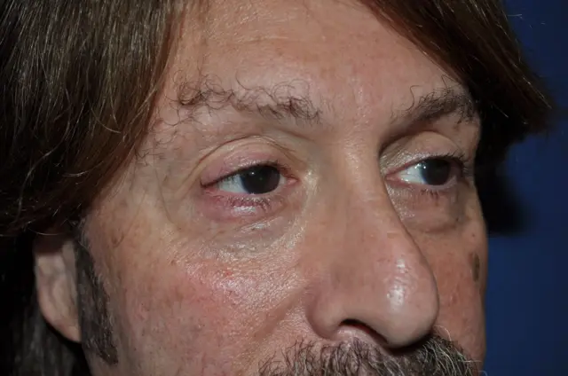 Blepharoplasty before at Aesthetic Surgery Center: Michael R. Macdonald, M.D. in San Francisco, CA