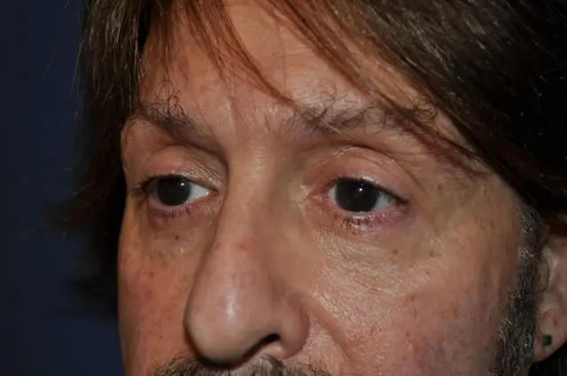 Blepharoplasty after at Aesthetic Surgery Center: Michael R. Macdonald, M.D. in San Francisco, CA