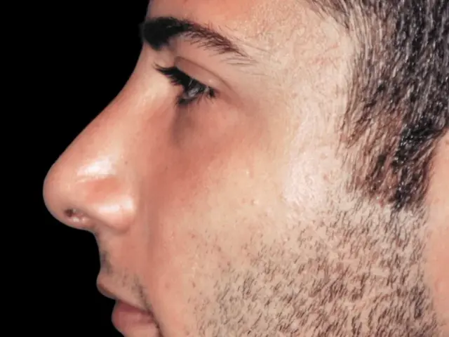 Functional Rhinoplasty after at Aesthetic Surgery Center: Michael R. Macdonald, M.D. in San Francisco, CA
