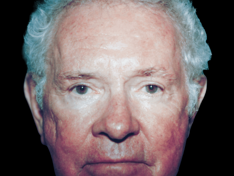 Aesthetic Surgery Center: Michael R. Macdonald, M.D. neck lift after — San Francisco, CA
