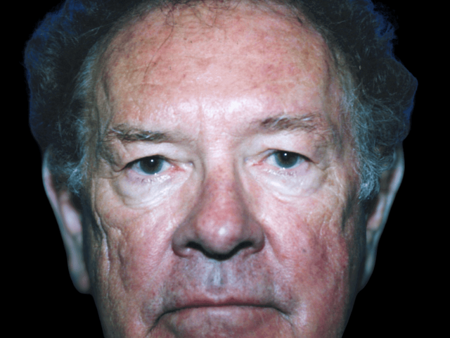 Neck Lift before at Aesthetic Surgery Center: Michael R. Macdonald, M.D. in San Francisco, CA