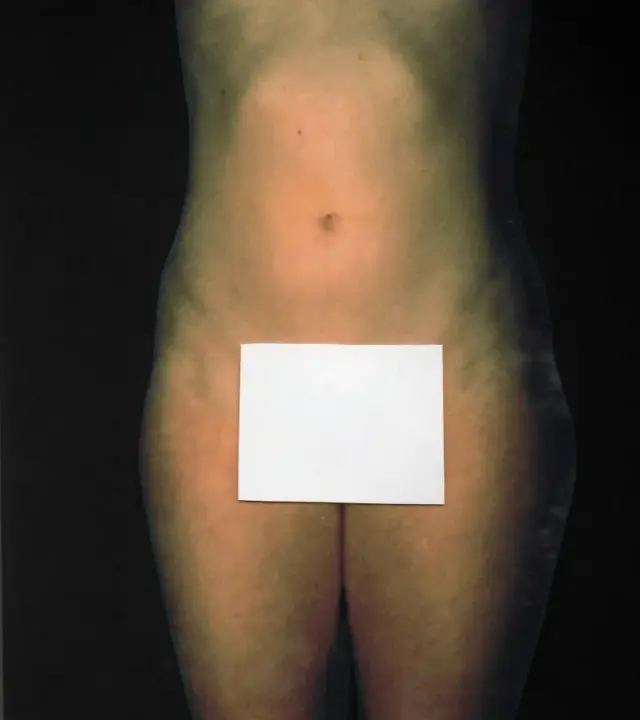 Liposuction before at Aesthetic Surgery Center: Michael R. Macdonald, M.D. in San Francisco, CA
