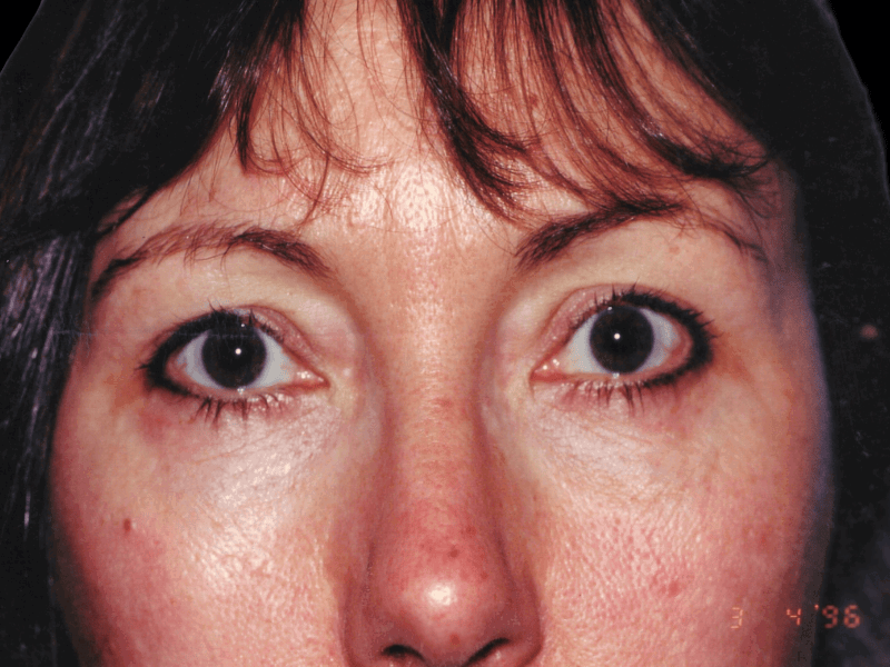 Aesthetic Surgery Center: Michael R. Macdonald, M.D. neck lift after — San Francisco, CA