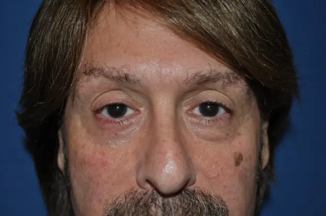 Blepharoplasty before at Aesthetic Surgery Center: Michael R. Macdonald, M.D. in San Francisco, CA