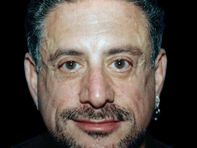 Aesthetic Surgery Center: Michael R. Macdonald, M.D. neck lift after — San Francisco, CA