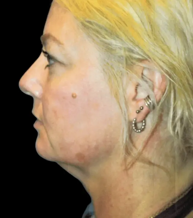 Deep Plane Facelift before at Aesthetic Surgery Center: Michael R. Macdonald, M.D. in San Francisco, CA