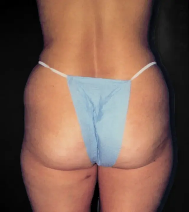 Liposuction before at Aesthetic Surgery Center: Michael R. Macdonald, M.D. in San Francisco, CA