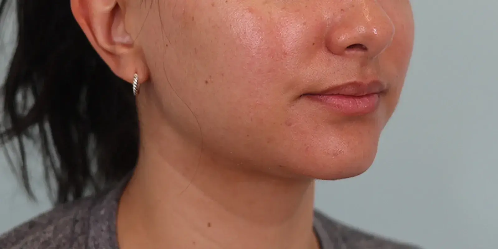Bay Hills Plastic Surgery neck lift after — Alamo, CA