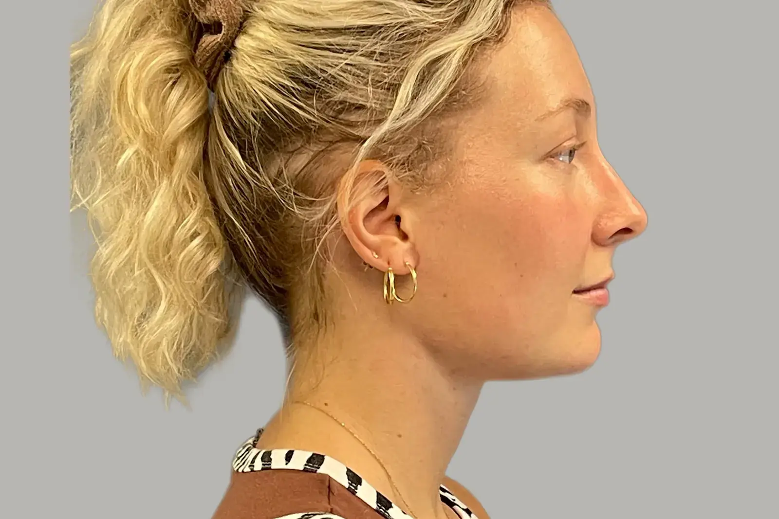Bay Hills Plastic Surgery neck lift after — Alamo, CA