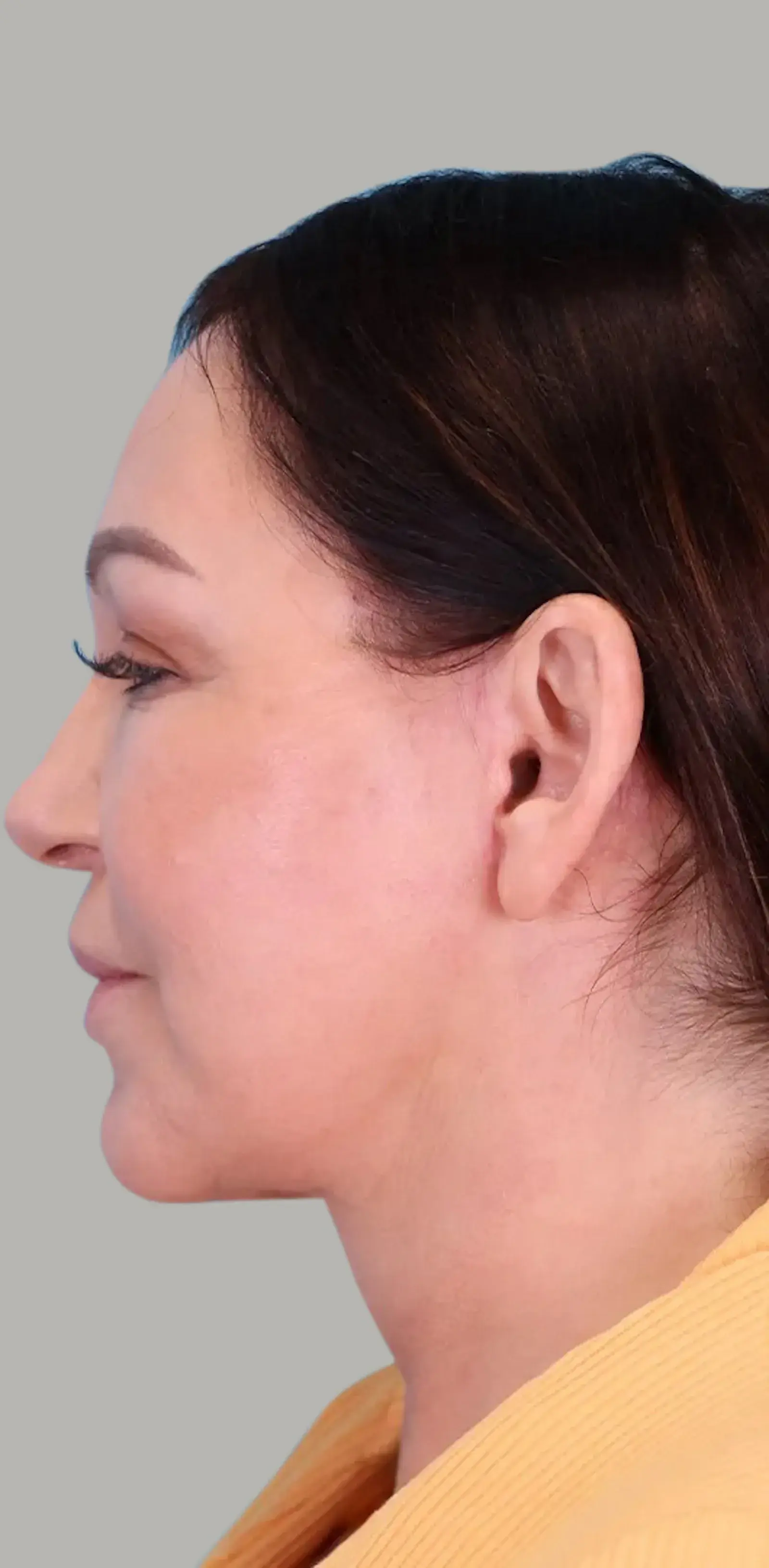Bay Hills Plastic Surgery facelift after — Alamo, CA