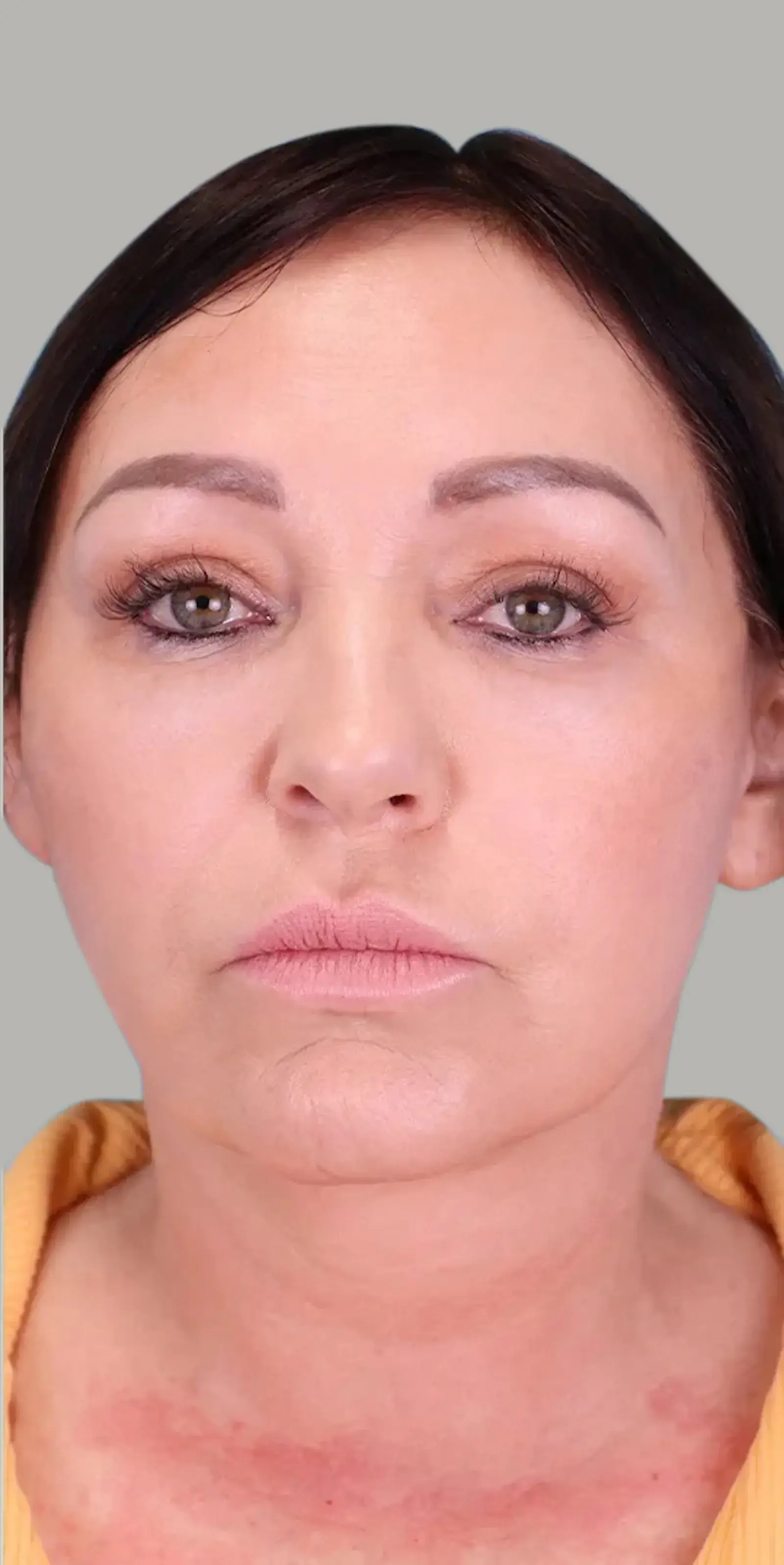 Bay Hills Plastic Surgery facelift after — Alamo, CA