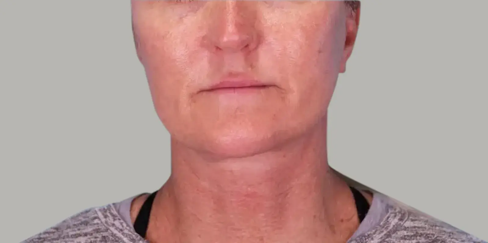 Bay Hills Plastic Surgery facelift after — Alamo, CA