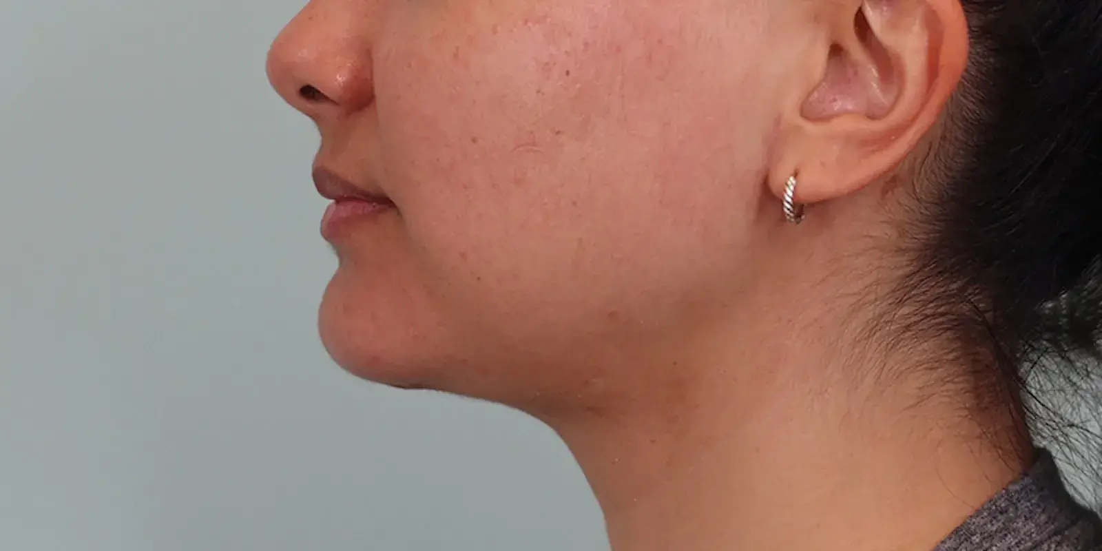 Bay Hills Plastic Surgery neck lift after — Alamo, CA