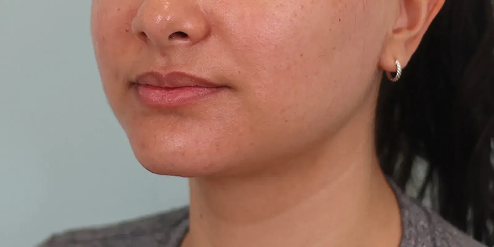 Bay Hills Plastic Surgery neck lift after — Alamo, CA