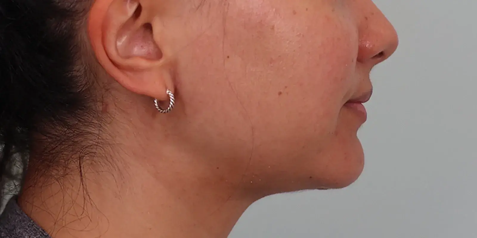 Bay Hills Plastic Surgery neck lift after — Alamo, CA