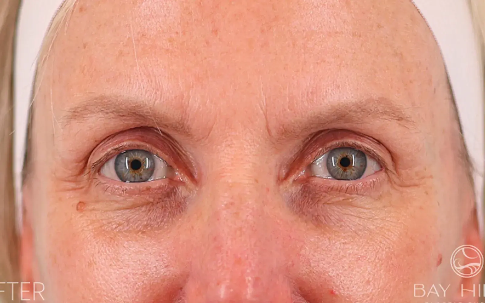 Bay Hills Plastic Surgery brow lift after — Alamo, CA