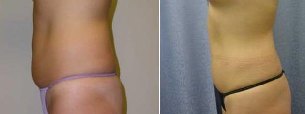 Liposuction result at Westfield Plastic Surgery Center in Omaha, NE