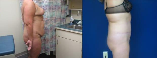 Tummy Tuck result at Westfield Plastic Surgery Center in Omaha, NE