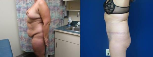 Tummy Tuck result at Westfield Plastic Surgery Center in Omaha, NE