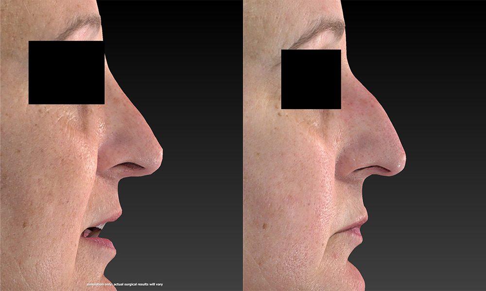 Westfield Plastic Surgery Center rhinoplasty result — Omaha, NE
