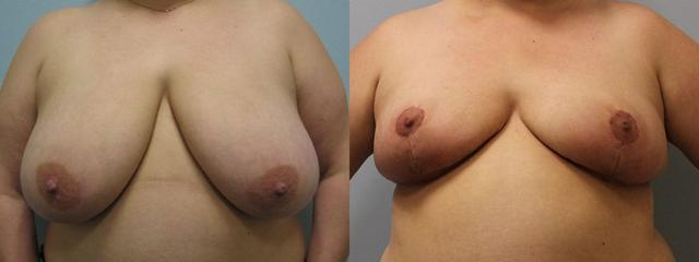 Breast Reduction result at Westfield Plastic Surgery Center in Omaha, NE