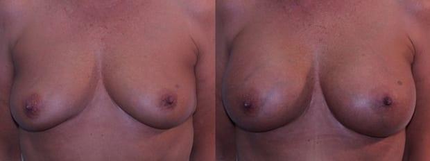 Breast Augmentation result at Westfield Plastic Surgery Center in Omaha, NE