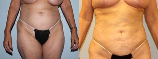 Liposuction result at Westfield Plastic Surgery Center in Omaha, NE