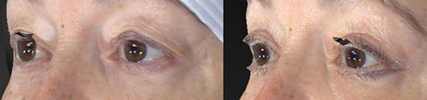 Blepharoplasty result at Westfield Plastic Surgery Center in Omaha, NE