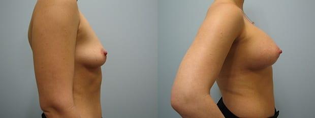 Breast Augmentation result at Westfield Plastic Surgery Center in Omaha, NE
