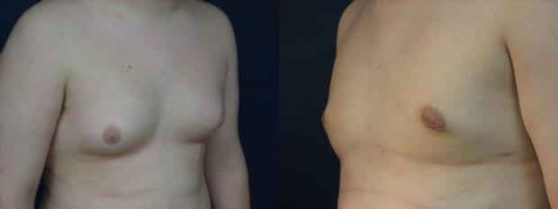 Gynecomastia Surgery result at Westfield Plastic Surgery Center in Omaha, NE