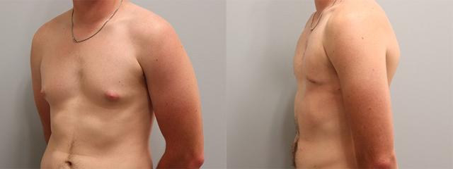 Gynecomastia Surgery result at Westfield Plastic Surgery Center in Omaha, NE