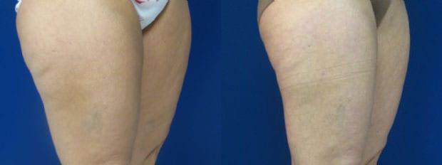 Liposuction result at Westfield Plastic Surgery Center in Omaha, NE