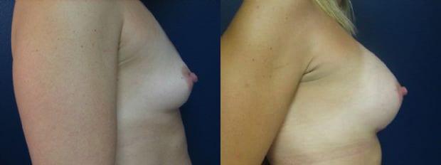 Breast Augmentation result at Westfield Plastic Surgery Center in Omaha, NE