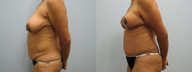 Mommy Makeover result at Westfield Plastic Surgery Center in Omaha, NE