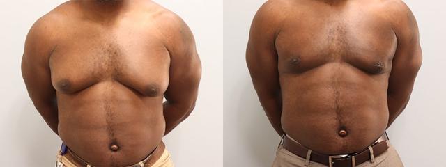 Gynecomastia Surgery result at Westfield Plastic Surgery Center in Omaha, NE