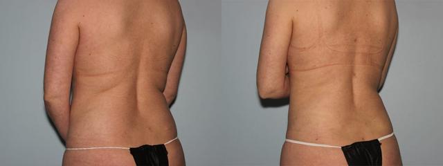 Liposuction result at Westfield Plastic Surgery Center in Omaha, NE