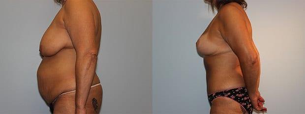 Mommy Makeover result at Westfield Plastic Surgery Center in Omaha, NE